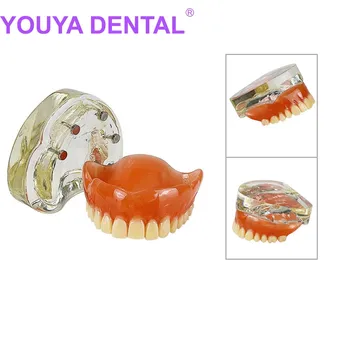 Zobu Implantācija, Zobu Modelis Demo Overdenture Restaurācija Ar 4 Implanti Augšējā Maxillary Skaidrs, Akrila Modelis Zobārstniecība Demonstrat